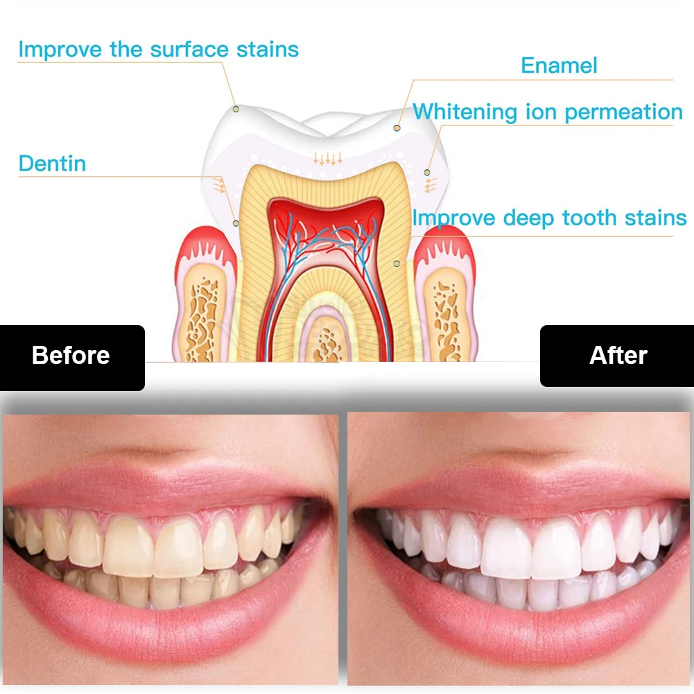 Dental Teeth Whitening Kit Min - Teeth Whitening With Trays 评论和价格