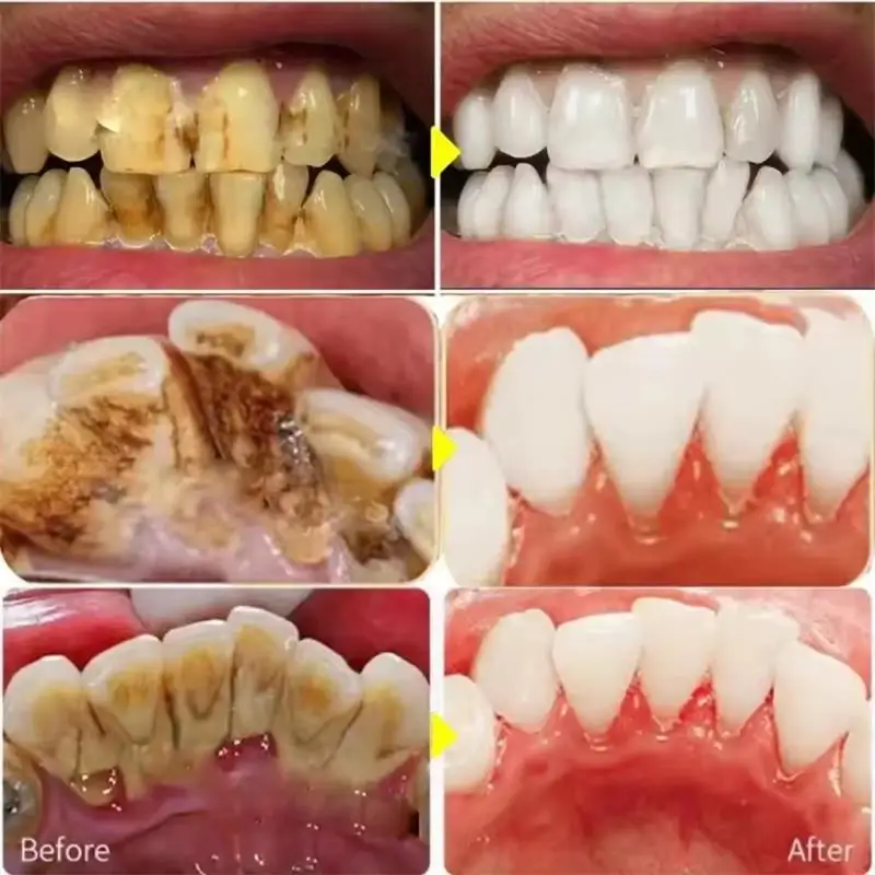 Fast Teeth Whtening Toothpaste - Whitening Pen Bleach 评论和价格