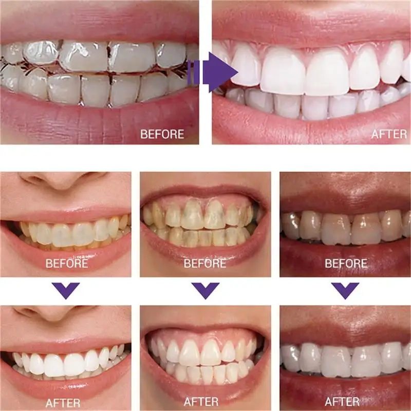 Fast Teeth Whtening Toothpaste - Whitening Pen Bleach 评论和价格